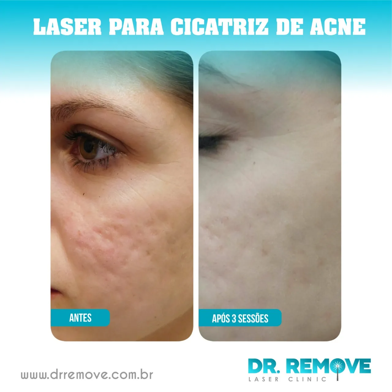 cicatriz de acne