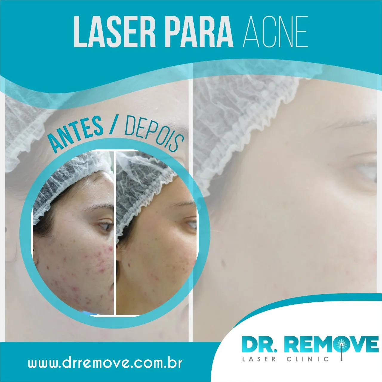 cicatriz de acne2