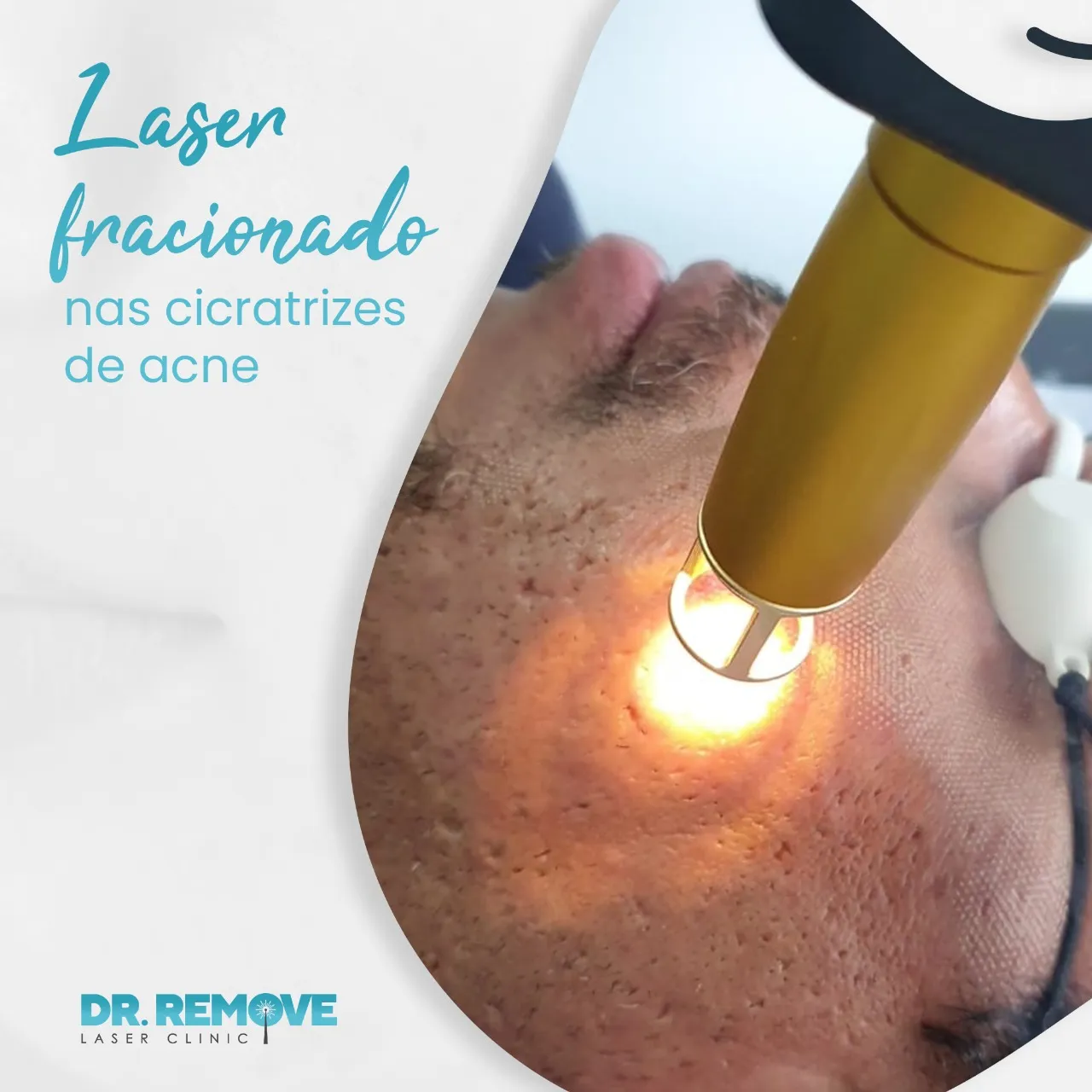 laser fracionado cicatriz de acne